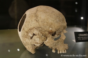 Crâne trépané, musée du château Grifeo de Trapanna
